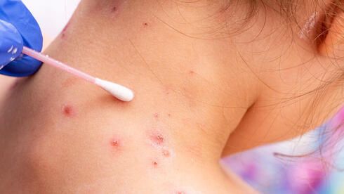 В России выявили первый случай заражения оспой обезьян