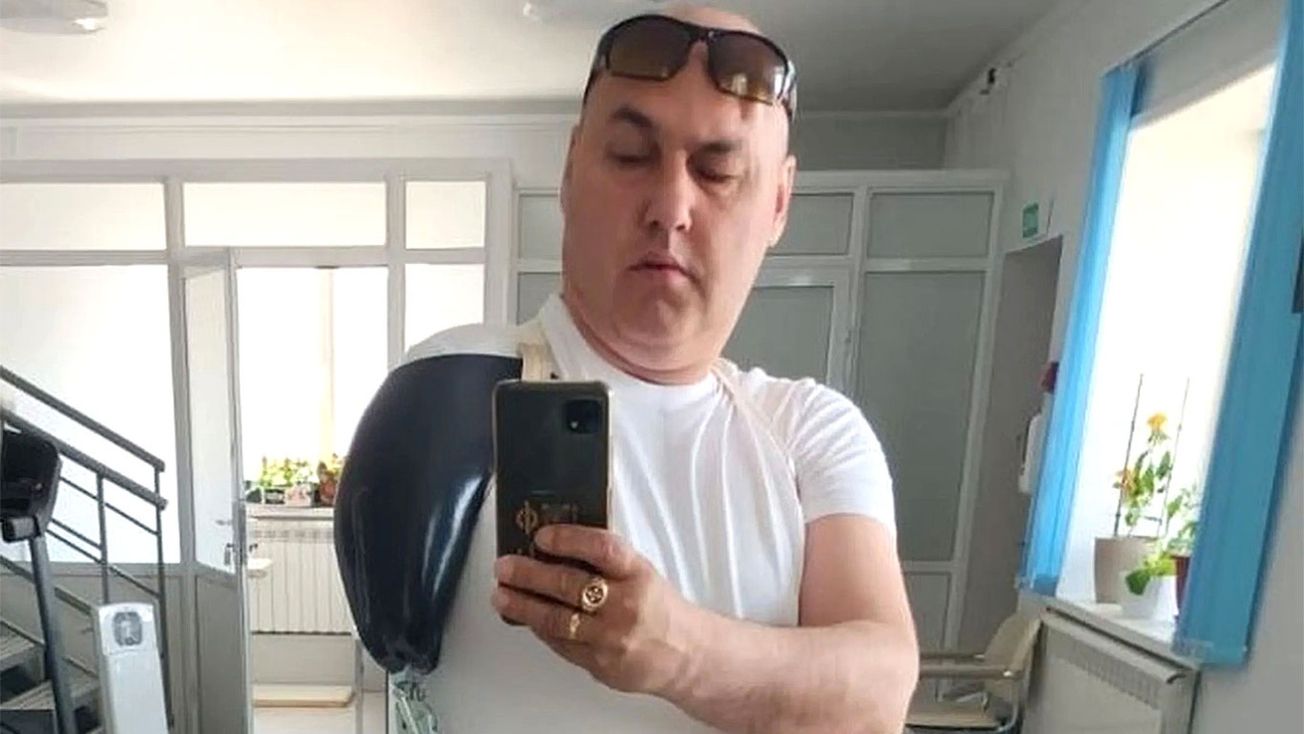 Потерявшему руку на войне в Украине россиянину дали металлическую палку вместо протеза